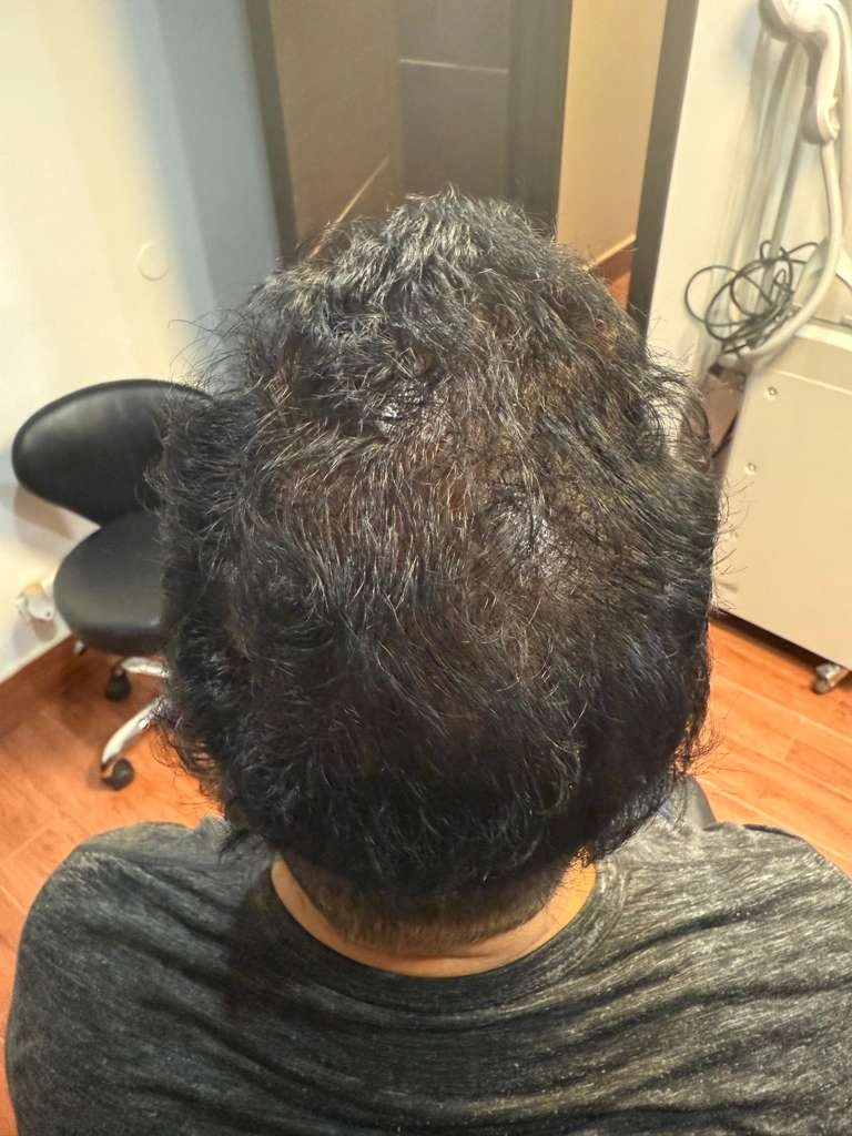 Overhead view showing top scalp thinning pattern before treatment