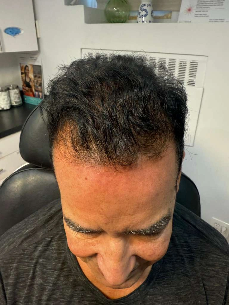 Front top view showing hairline and density before hair restoration