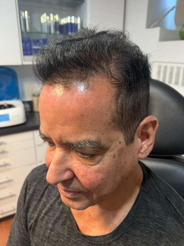 front view showing diffuse thinning before hair restoration