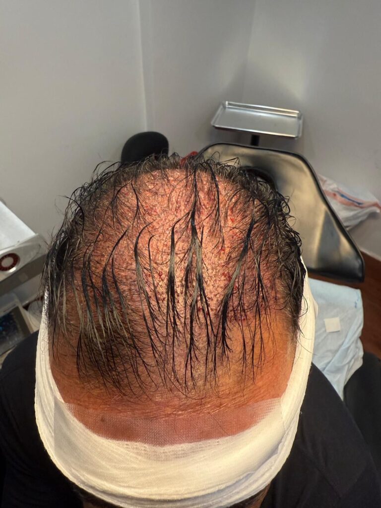 Immediate post hair transplant recipient area with protective bandage in clinic