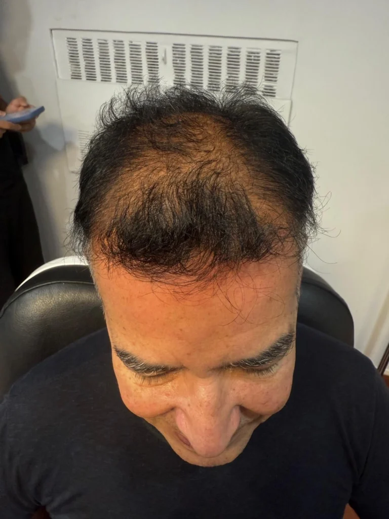 Left profile view of hairline and temple area before hair restoration