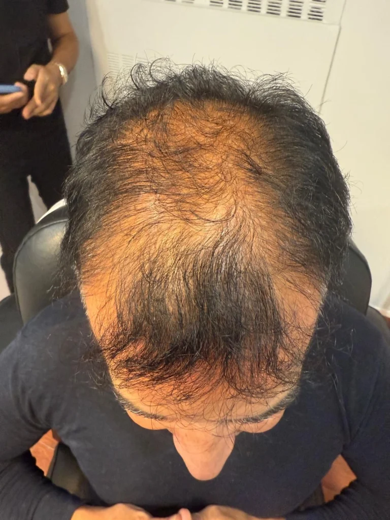 Overhead front view showing diffuse thinning before hair restoration