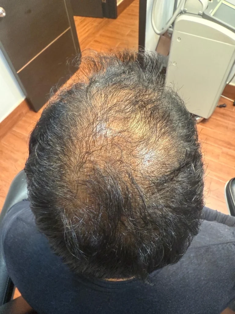 Angled front view of hairline and density before hair restoration