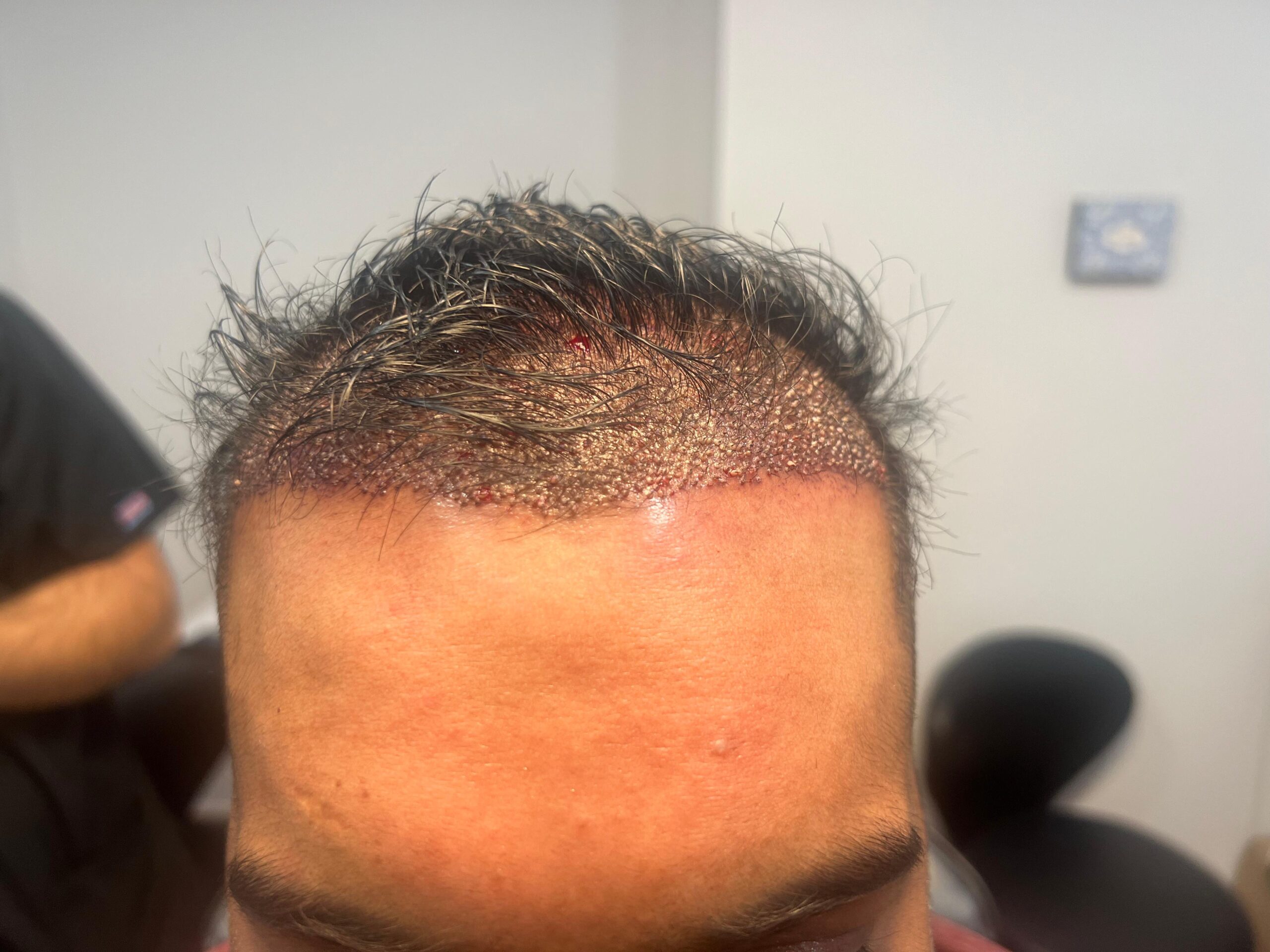 Hair restoration result